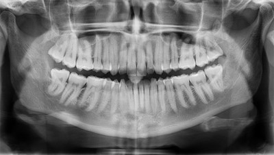 dental_x-rays-400x226
