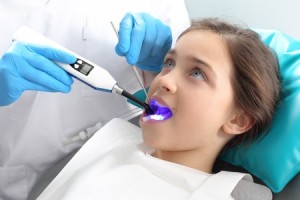 dental sealants