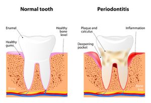 what is periodontal disease?